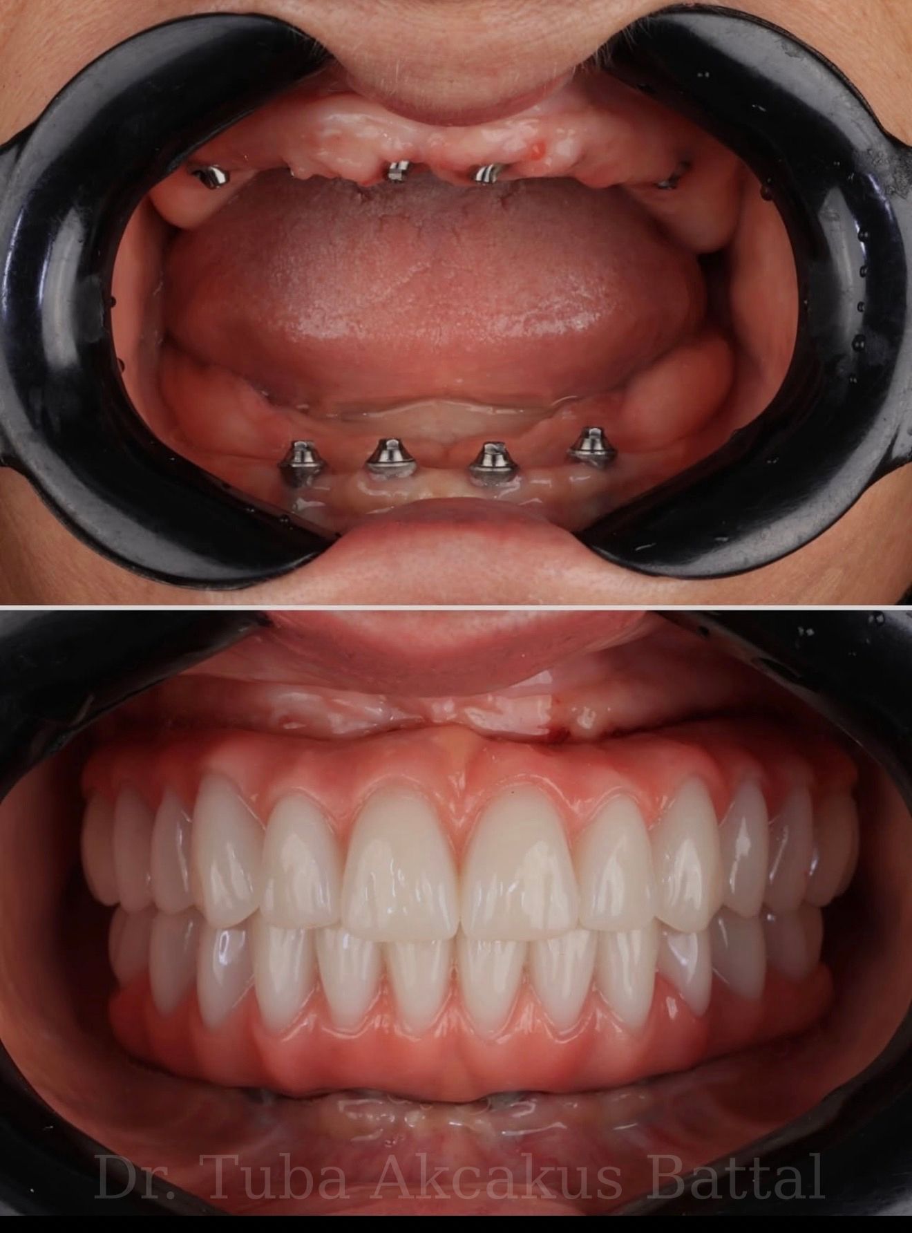 All-on-4 full arch implant result — Dr. Dt. Tuba Akcakus Battal