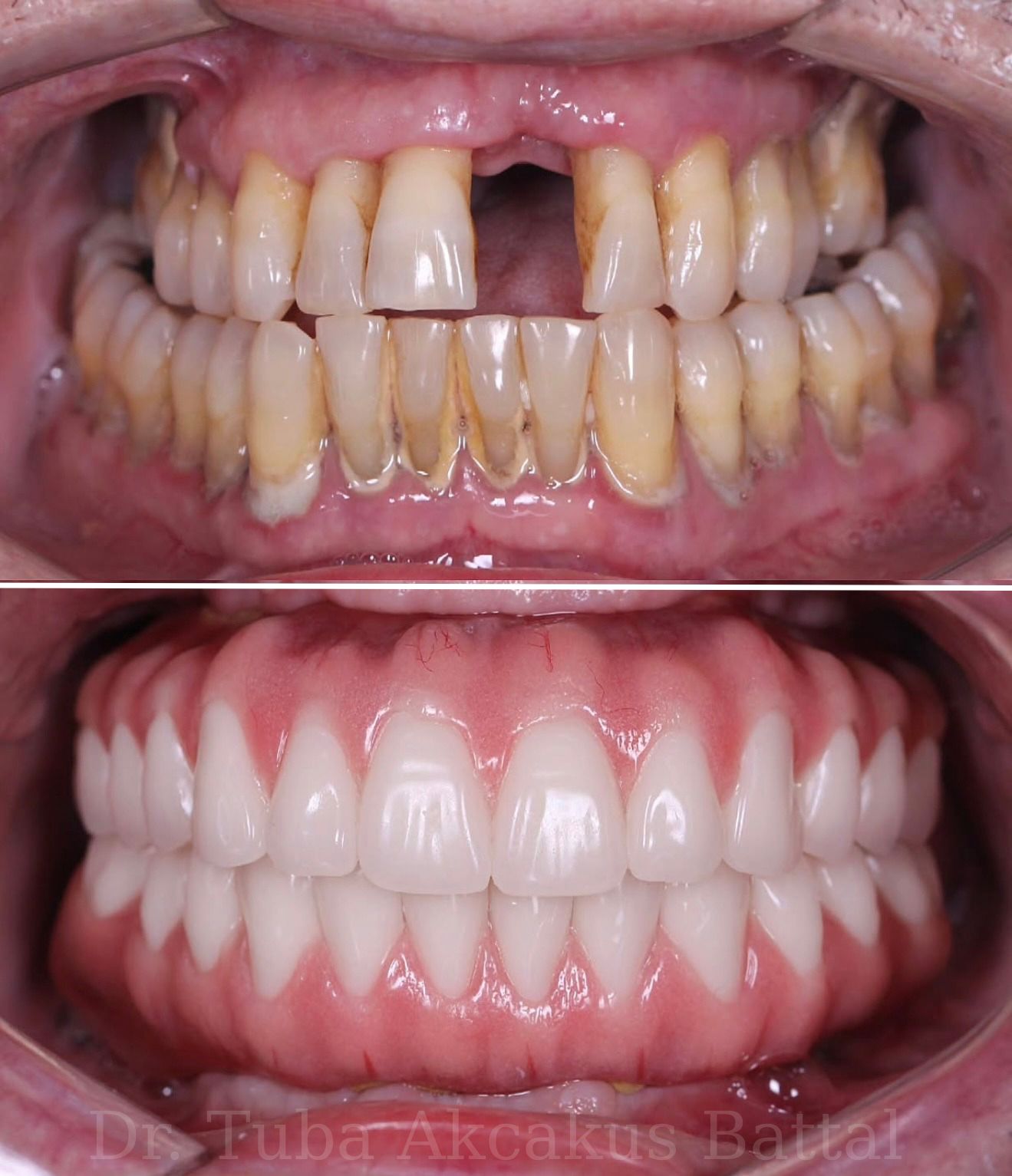 All-on-6 full arch implant result — Dr. Dt. Tuba Akcakus Battal