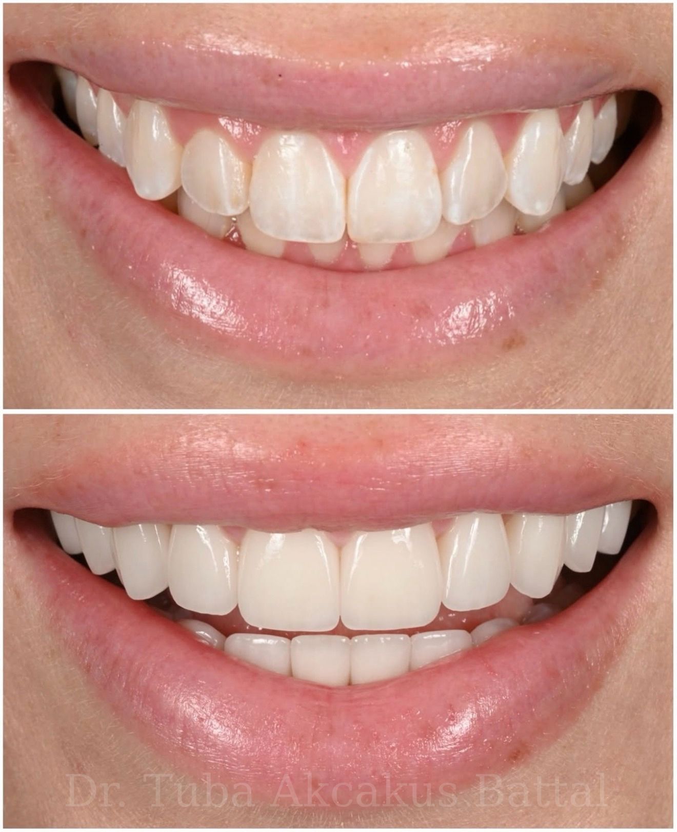Composite bonding smile result — Dr. Dt. Tuba Akcakus Battal