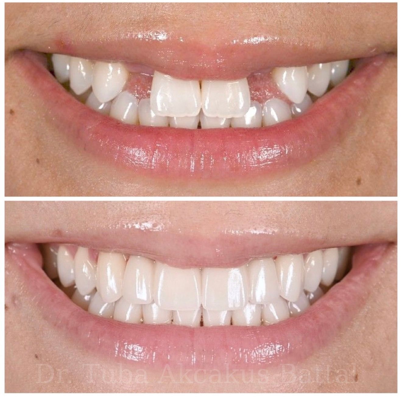 Dental implant with zirconium crown result — Dr. Dt. Tuba Akcakus Battal