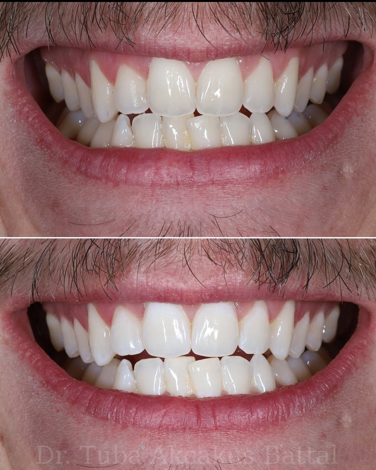 Laser teeth whitening result — Dr. Dt. Tuba Akcakus Battal