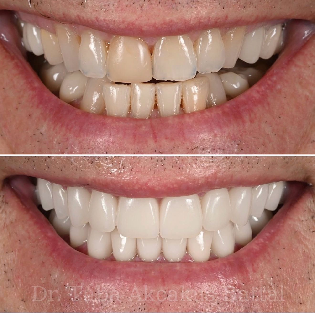 Porcelain veneer smile result — Dr. Dt. Tuba Akcakus Battal