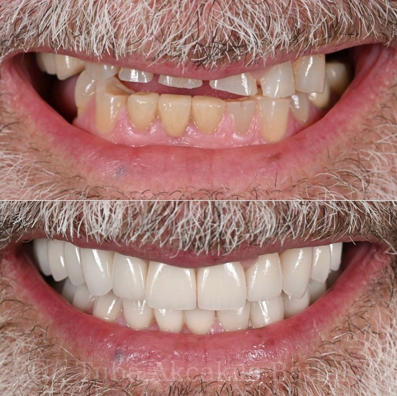 Zirconium crown result — Dr. Dt. Tuba Akcakus Battal