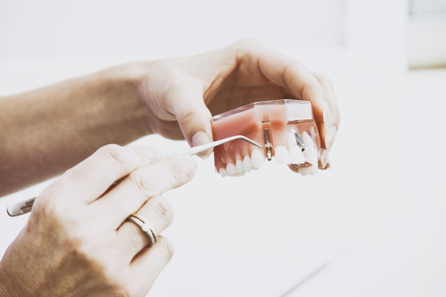 Full-arch implant prosthesis model showing implant distribution — Dr. Dt. Tuba Akcakus Battal