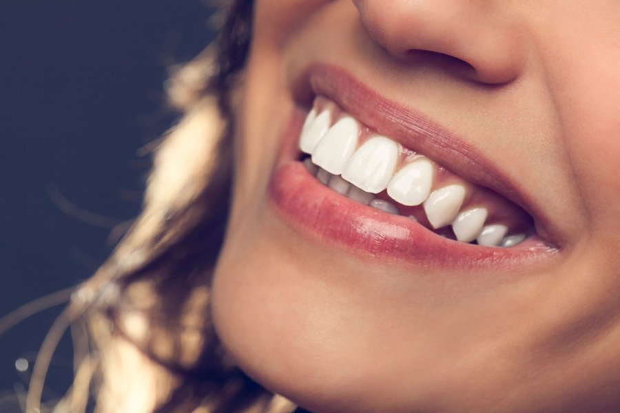 Natural beautiful smile after composite bonding — Dr. Dt. Tuba Akcakus Battal Antalya